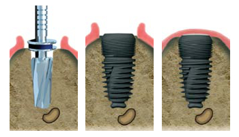 Spécialiste implant dentaire torcy