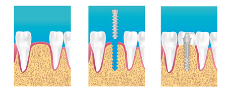 Implants dentaires torcy